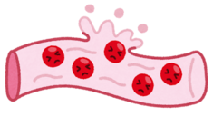 イラスト:ダメージを受けた血管